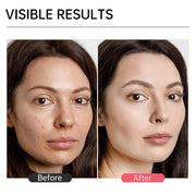 Niacinamide Dark Spot Remover Serum for Face Whitening Moisturizer Hyaluronic Acid Removal Freckle Facial Serum Skin Care